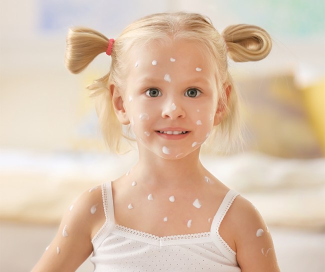 Petite fille avec la varicelle sur le visage