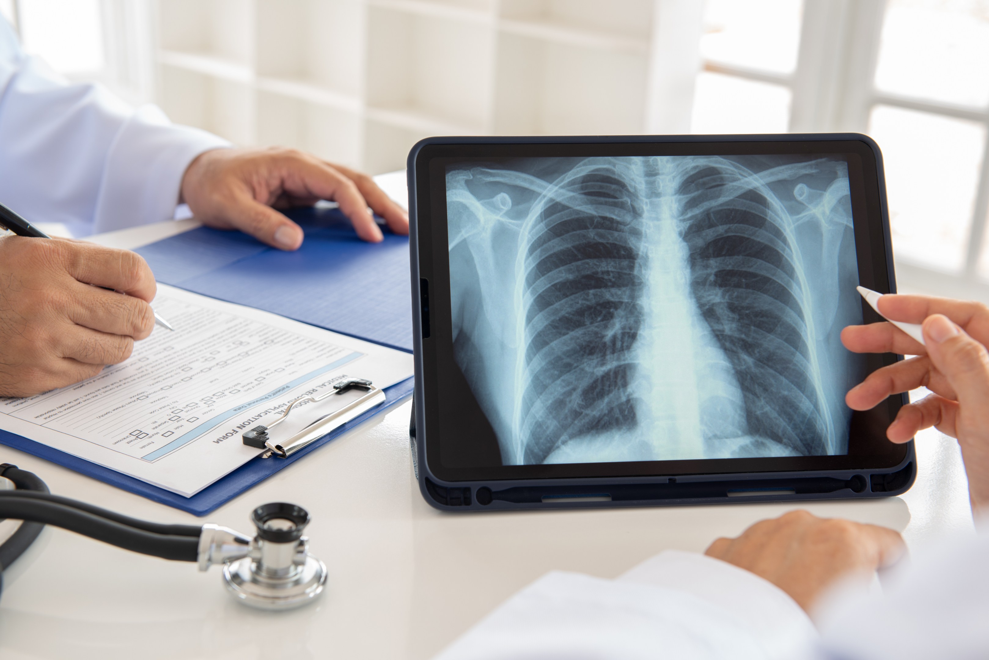 Équipe médicale examinant des radiographies des poumons d’un patient afin de dépister une maladie pulmonaire.